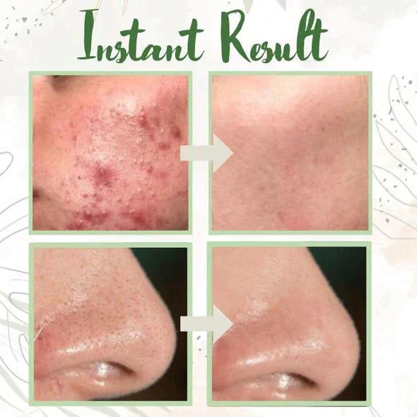 Final Sale - Oveallgo® Green Tea Deep Cleanse Mask - （Limited time discount 🔥 last day）