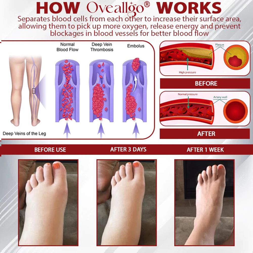Oveallgo® Advanced CVI Edema Therapy Cream