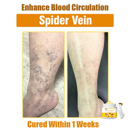 ✅Official Store Oveallgo™ Bee Venom Comprehensive Cream: Anti-aging, Hydrating, Skin Repair, Even Tone, Acne and Dark Spot Treatment, Wartand Mole Removal, PsoriasisRelief. (FDA Approved)