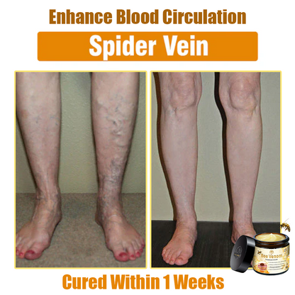 ✅Official Store: Oveallgo™ Bee Venom Skin Treatment Cream (𝐴𝐴𝐷 𝑅𝑒𝑐𝑜𝑚𝑚𝑒𝑛𝑑𝑒𝑑) ✨Anti-aging, Hydrating, Skin Repair, Even Tone, Acne and Dark Spot Treatment, Wartand Mole Removal, PsoriasisRelief