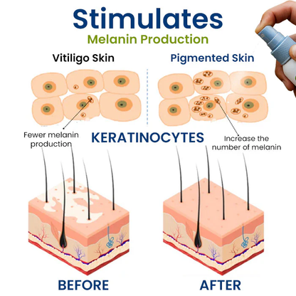 Fivfivgo® Vitiligo Treatment Spray