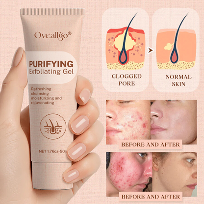 Oveallgo® Purifying Exfoliating Gel for Acanthosis Nigricans, Exfoliation, Dark Spots, Skin Tags, and Eczema_Ultra01
