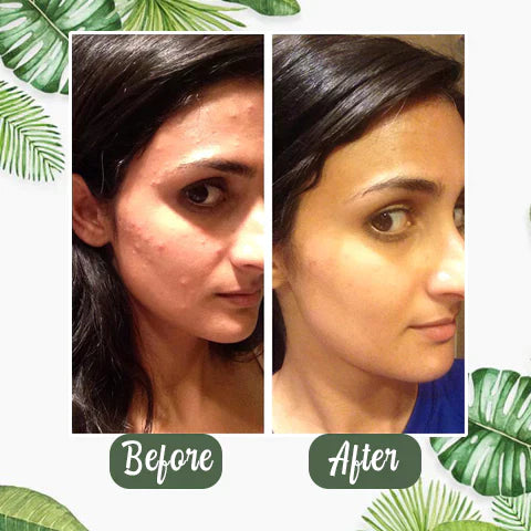 Final Sale - Oveallgo® Green Tea Deep Cleanse Mask - （Limited time discount 🔥 last day）