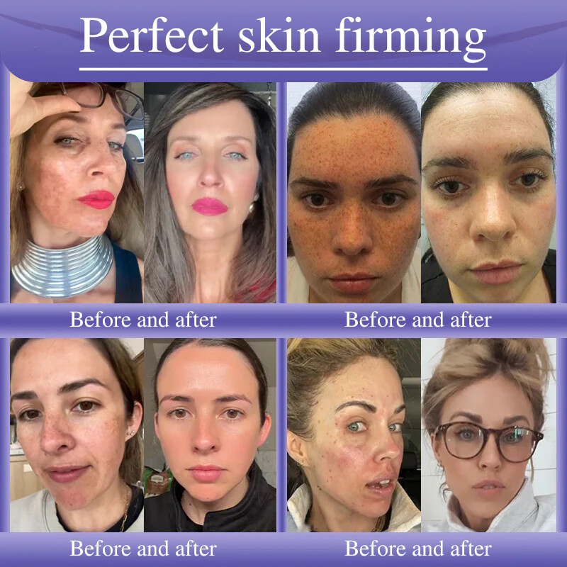 Oveallgo® Anti-Wrinkle Cream To Eliminate Wrinkles, Firm And Whiten The Skin - Last offer! 🔥90% discount