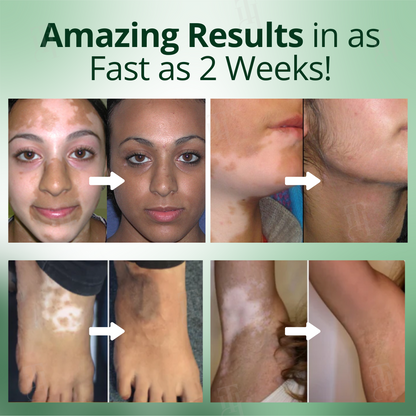 Fivfivgo® Vitiligo Treatment Cream