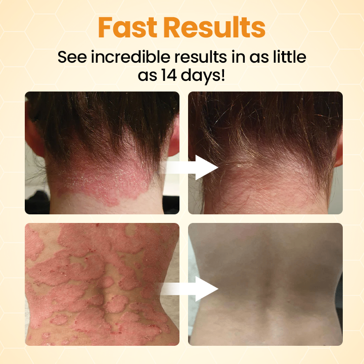 Oveallgo® BeeVenom Soothe Psoriasis Relief Cream