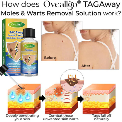 Oveallgo® TAGAway Moles & Warts Removal Solution