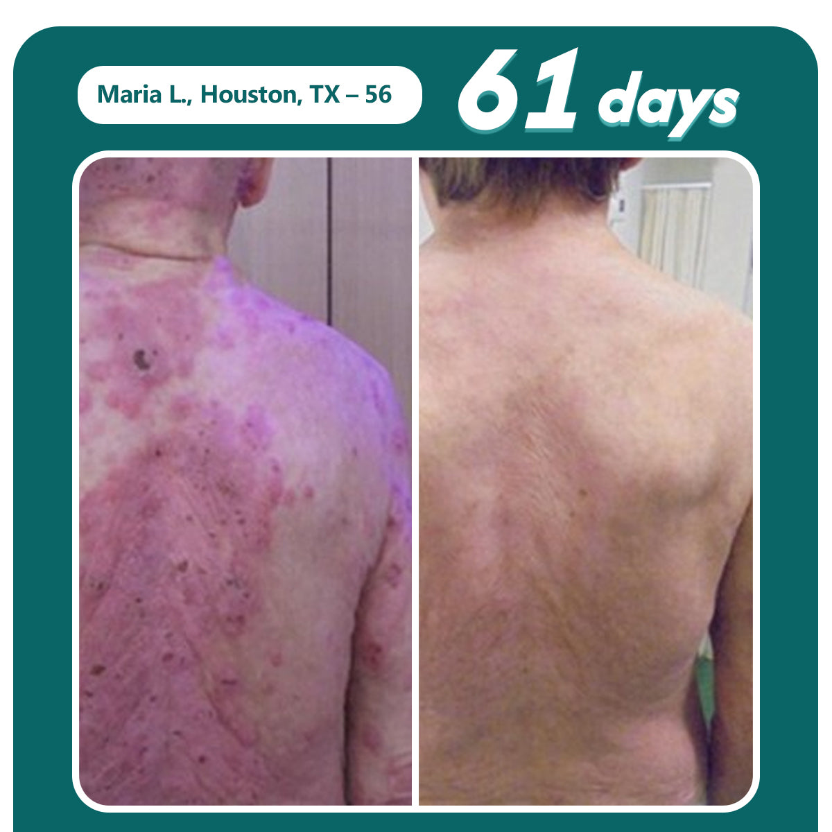 Oveallgo® Shingles Calm Snake Peptide Ampoules 19 Oveallgo® Shingles Calm Snake Peptide Ampoules