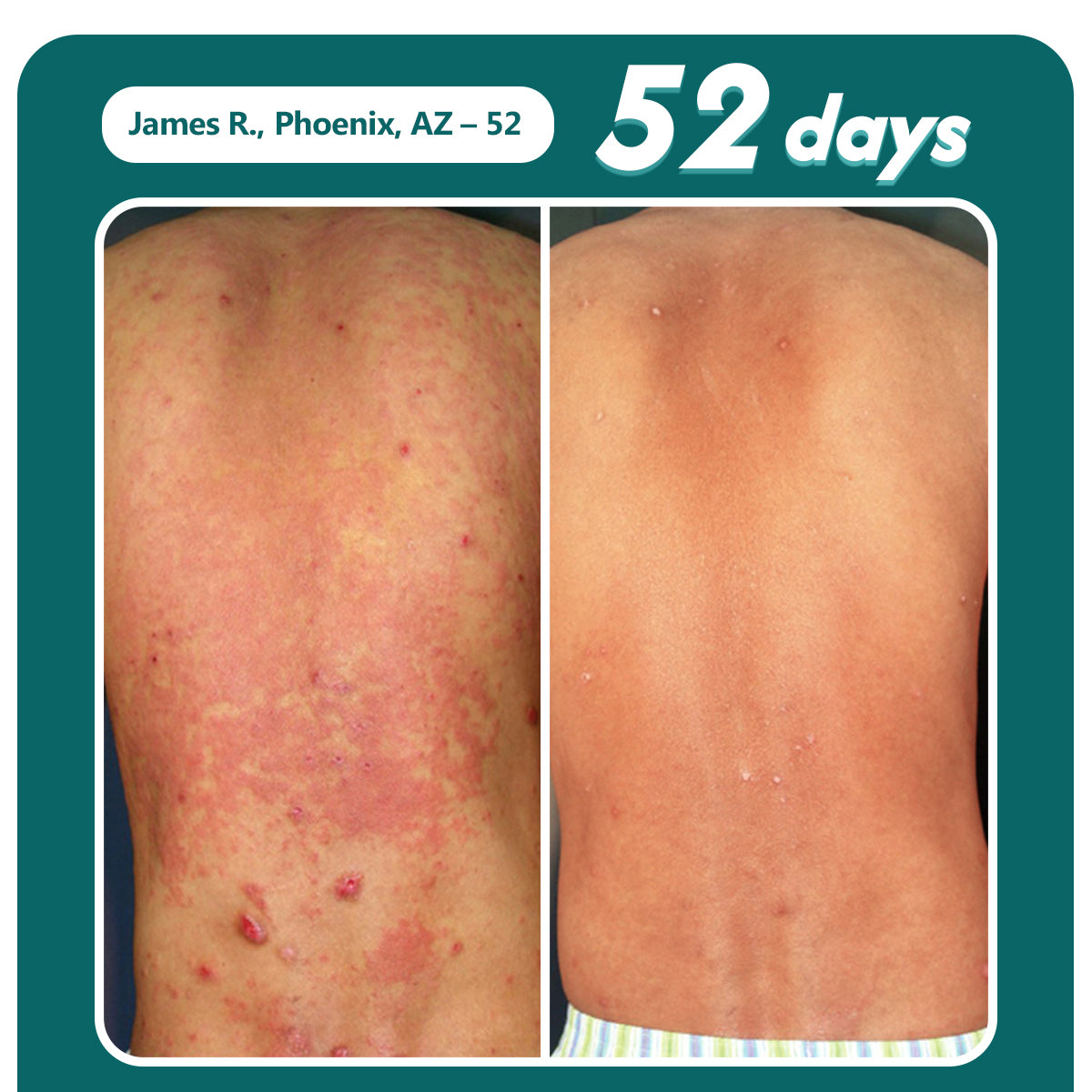 Oveallgo® Shingles Calm Snake Peptide Ampoules 20 Oveallgo® Shingles Calm Snake Peptide Ampoules