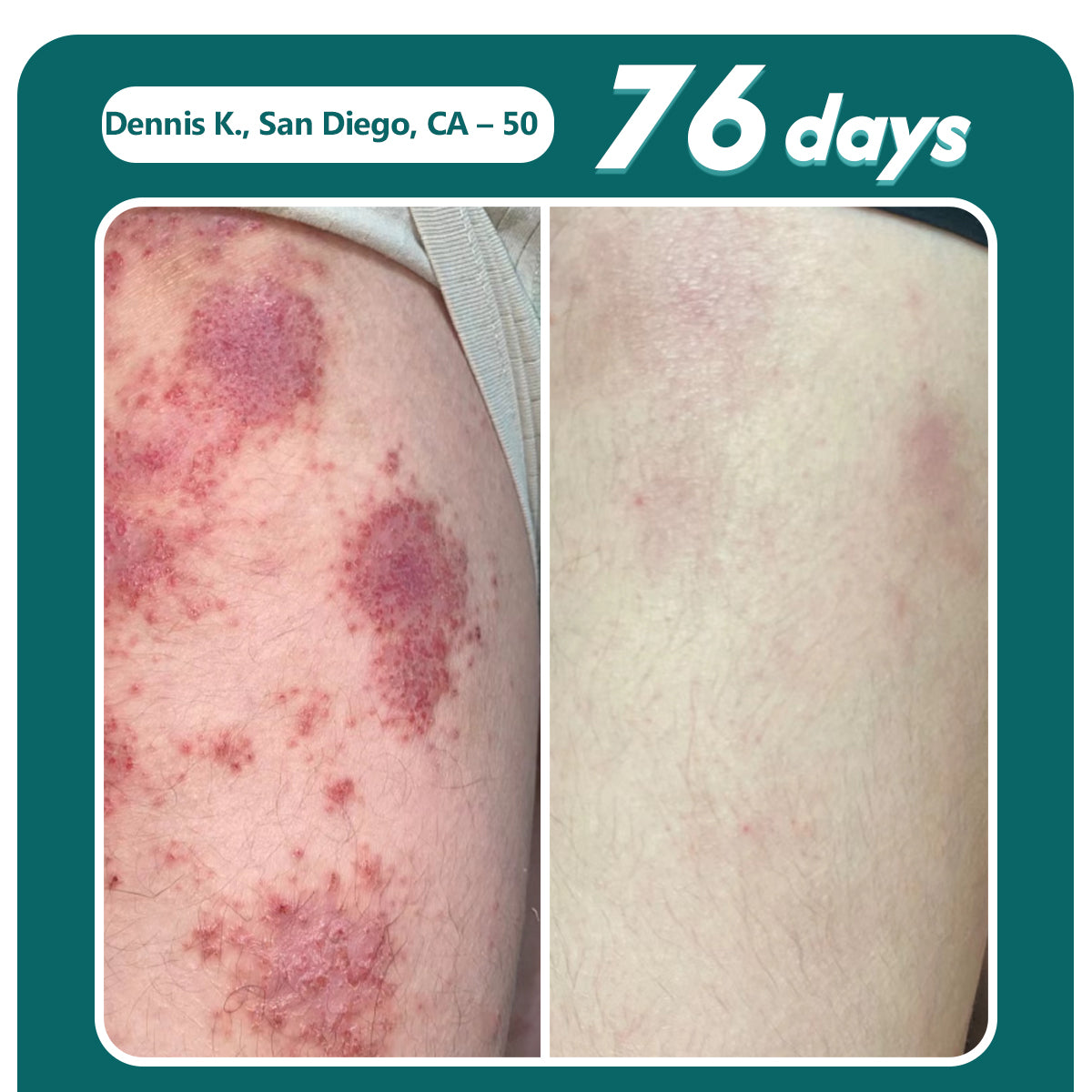 Oveallgo® Shingles Calm Snake Peptide Ampoules 22 Oveallgo® Shingles Calm Snake Peptide Ampoules