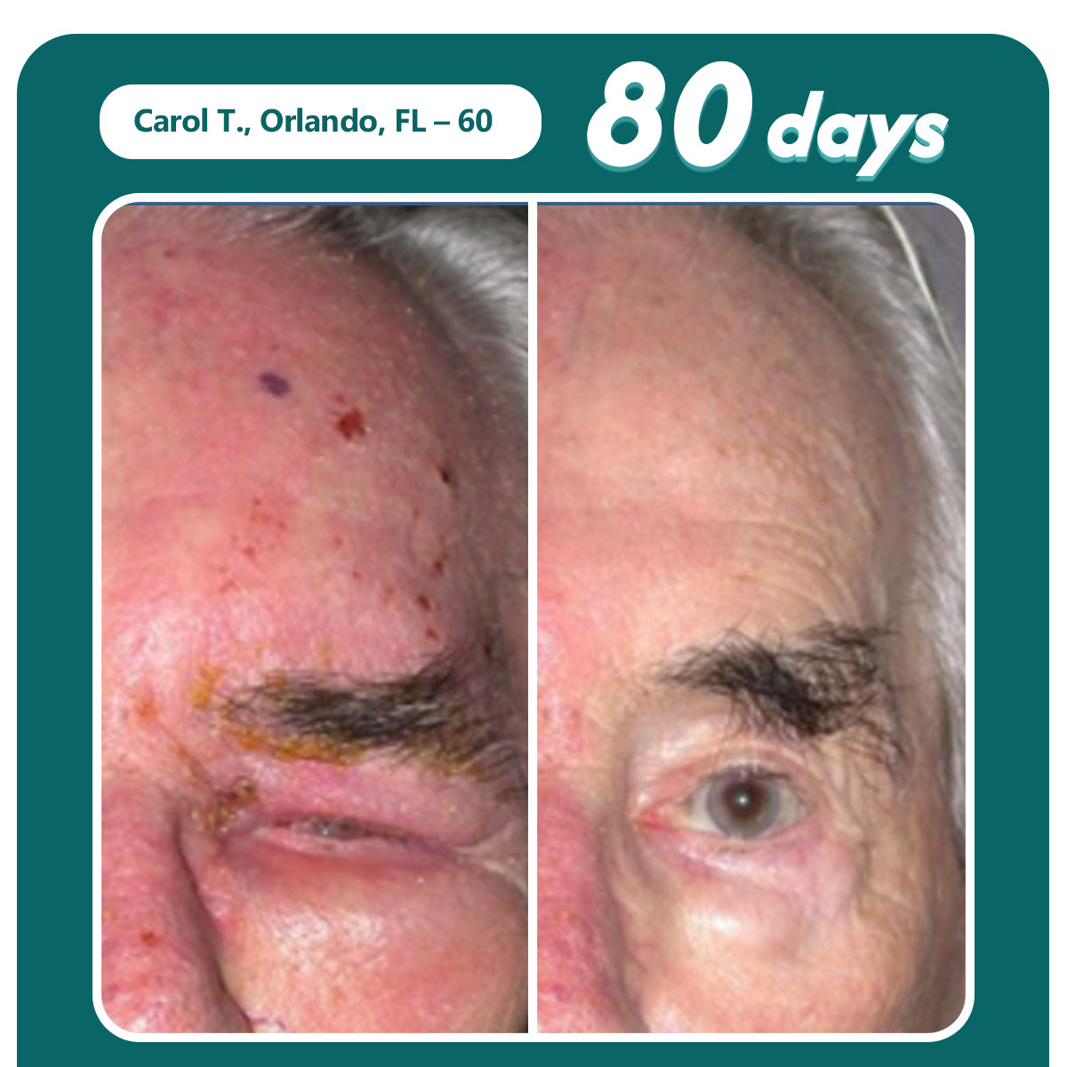 Oveallgo® Shingles Calm Snake Peptide Ampoules 21 Oveallgo® Shingles Calm Snake Peptide Ampoules