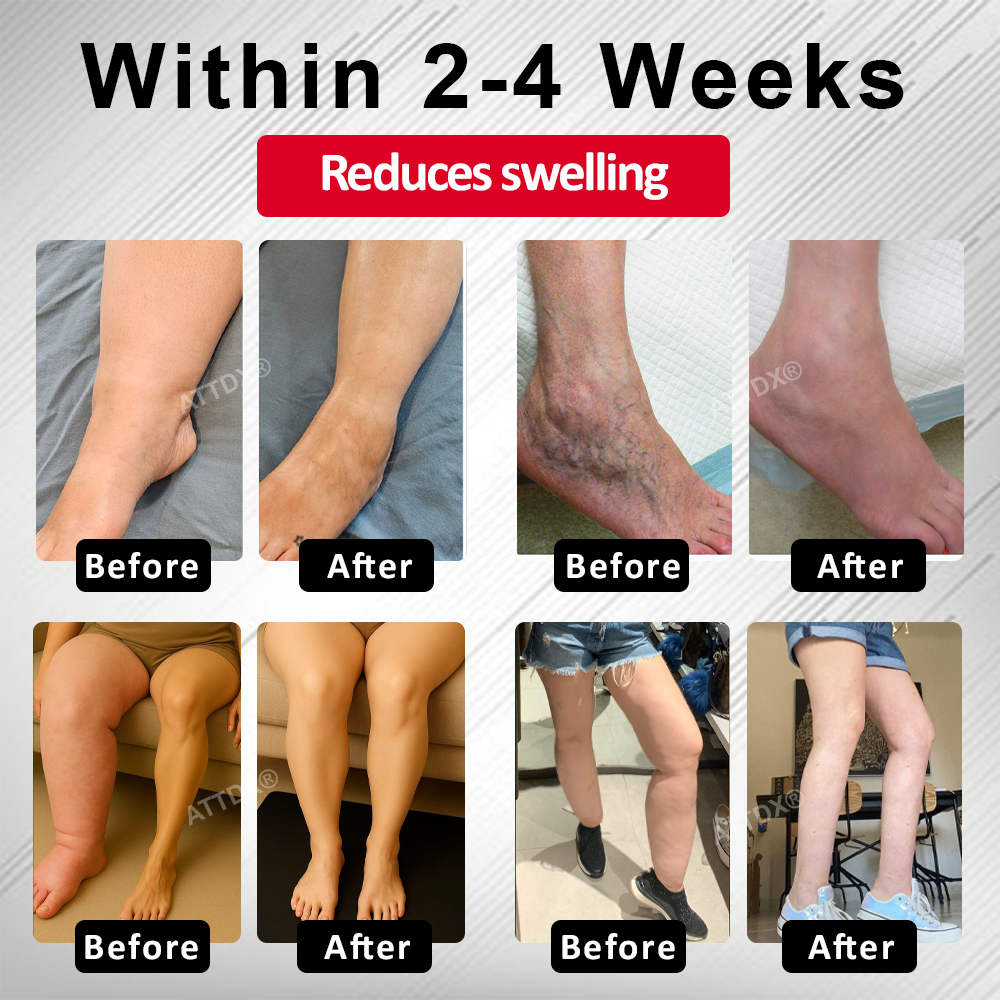 Oveallgo® Advanced CVI Edema Therapy Cream