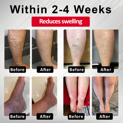 Oveallgo® Advanced CVI Edema Therapy Cream