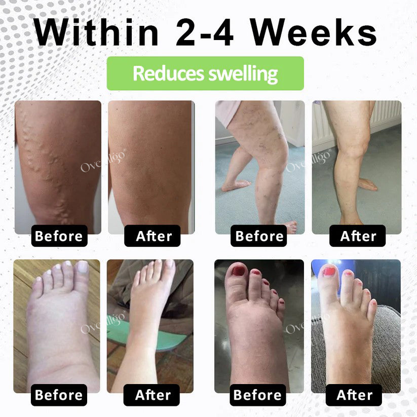 Oveallgo® CircuPro MAX Edema & Lymphatic Support Inhaler