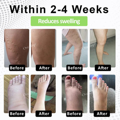 Oveallgo® CircuPro MAX Edema & Lymphatic Support Inhaler