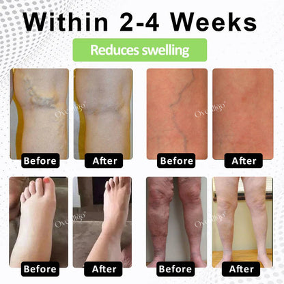 Oveallgo® CircuPro MAX Edema & Lymphatic Support Inhaler