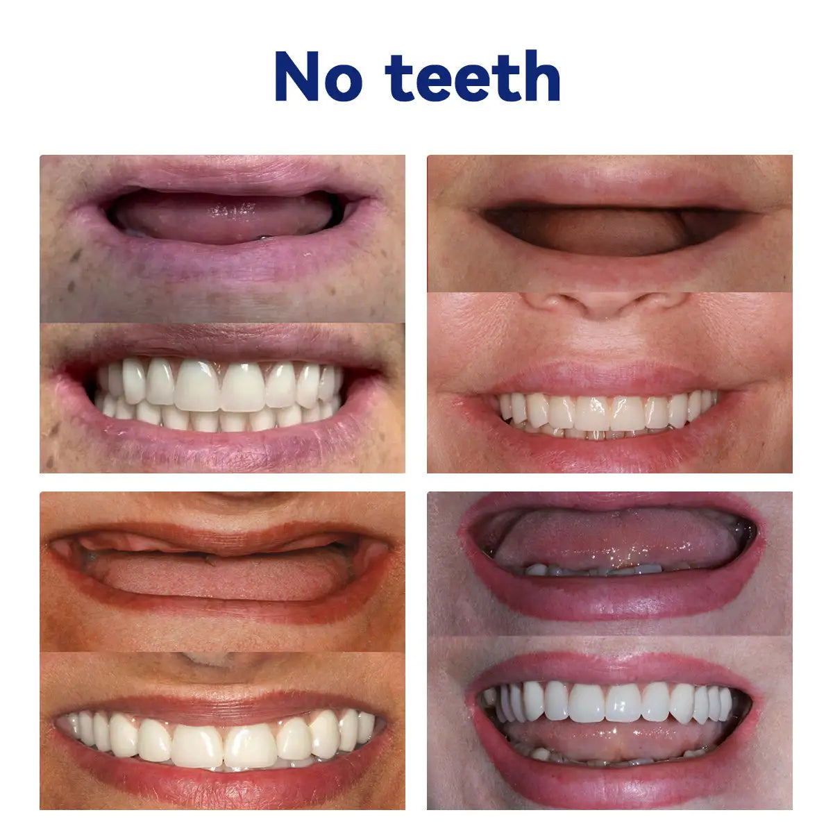 ✅ Official Store: 🦷Oveallgo™ 𝑆𝑖𝑙𝑖𝑐𝑜𝑛𝑒 𝐷𝑒𝑛𝑡𝑢𝑟𝑒 𝑅𝑢𝑙𝑒𝑟 𝑆𝑒𝑡 - 🌟 Perfect Fit for All-Day Comfort