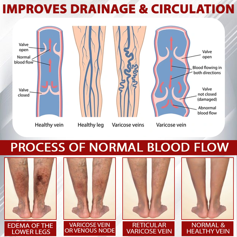 Oveallgo® Advanced CVI Edema Therapy Cream