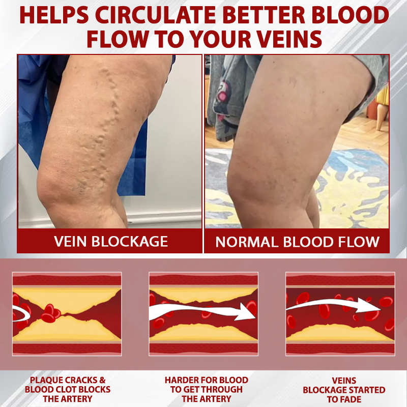 Oveallgo® Advanced CVI Edema Therapy Cream