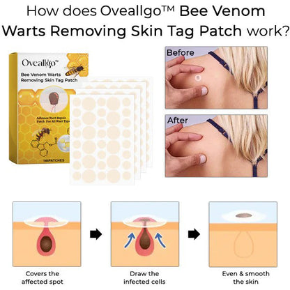 【OFFICIAL STORE】 Oveallgo™ Bee Venom Warts Removing Skin Tag Patch