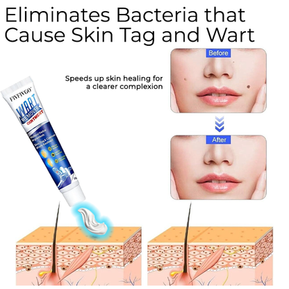 Bikenda® Mole and Wart Removal Laser Set