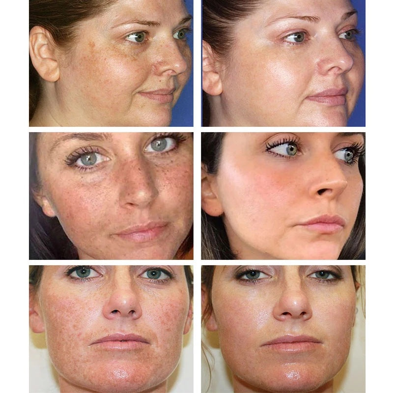 [Official Store] Oveallgo® Blemish Removing Beauty Cream – Fades Dark Spots, Freckles & Wrinkles | Age-Defying, Even-Tone Treatment