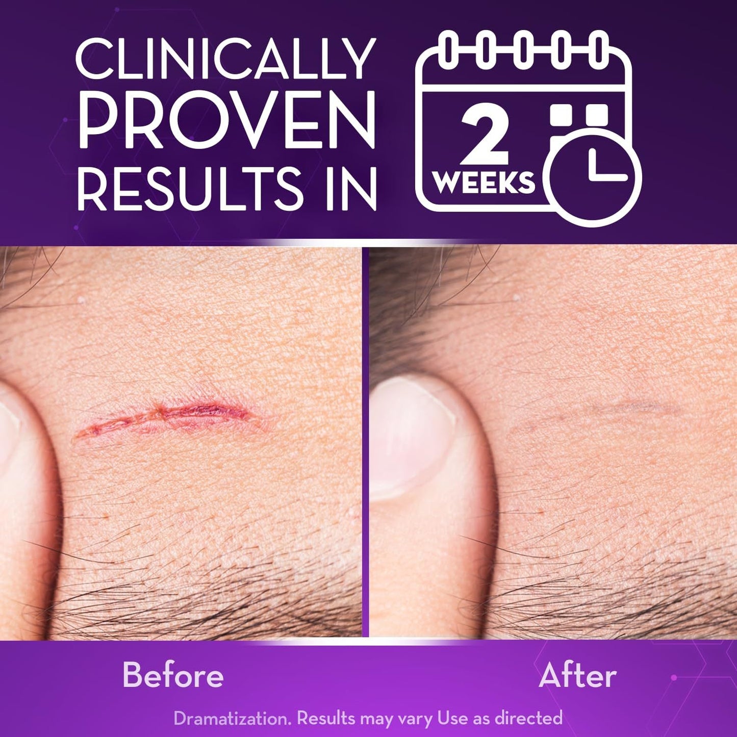 Oveallgo® Advanced Scar Gel Improve The Appearance Of Scars And Stretch Marks