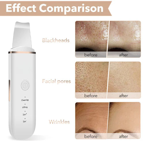 Oveallgo™ Ultrasonic Skin Spatula 14 Oveallgo™ Ultrasonic Skin Spatula