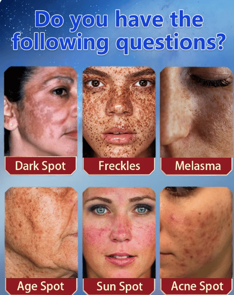 [Official Store] Oveallgo® Blemish Removing Beauty Cream – Fades Dark Spots, Freckles & Wrinkles | Age-Defying, Even-Tone Treatment
