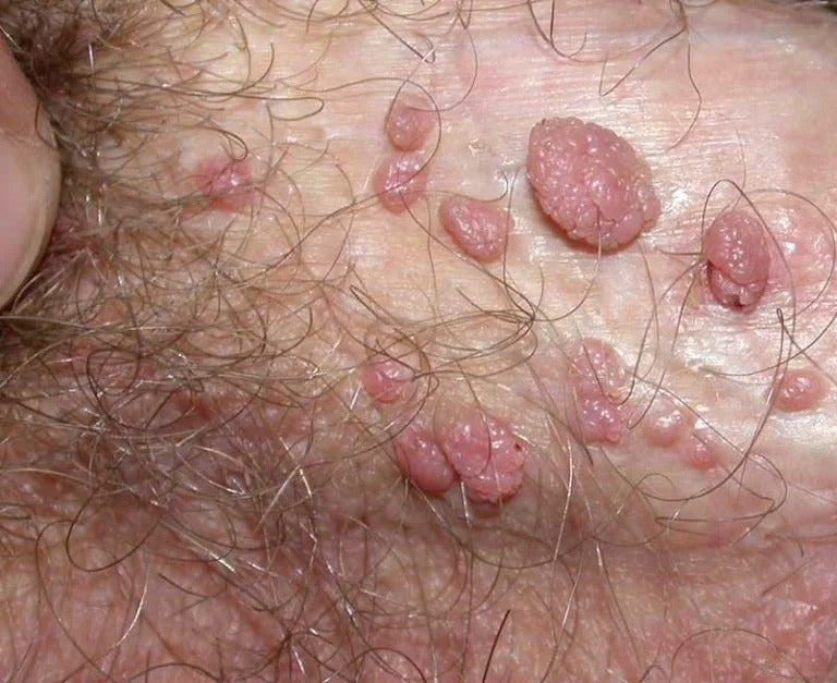 Oveallgo® NANOLIPO GENITAL WARTS CLINICAL AMPOULES