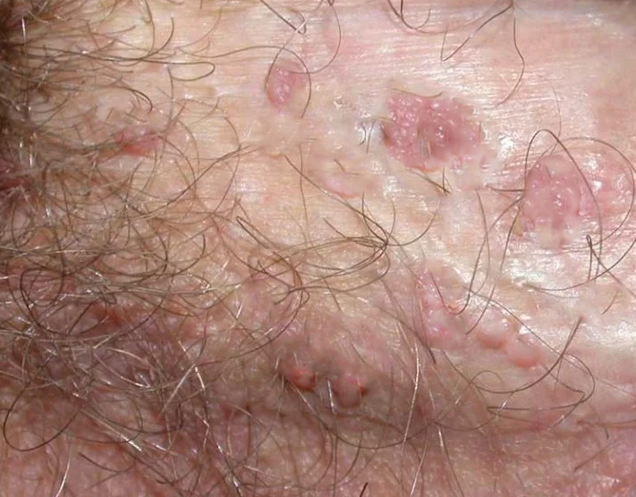 Oveallgo® NANOLIPO GENITAL WARTS CLINICAL AMPOULES